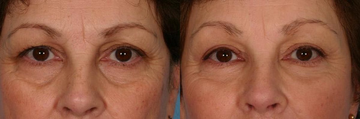 Facelift Before & After Gallery - Patient 209929 - Image 4