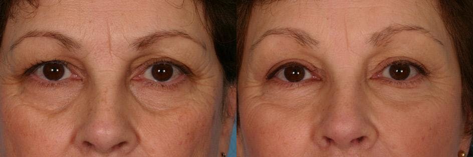 Facelift Before & After Gallery - Patient 209929 - Image 4