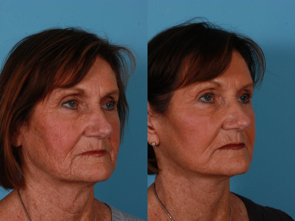 Limited Incision Facelift Before & After Gallery - Patient 583706 - Image 2