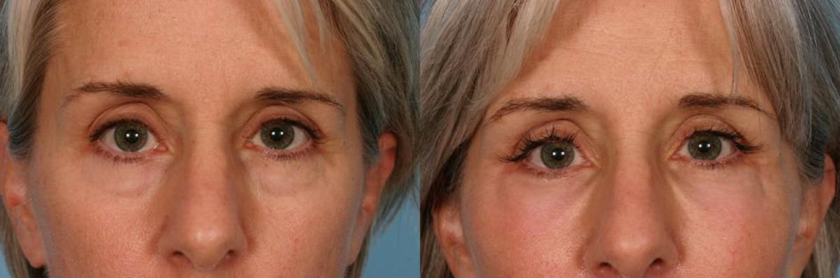 Facial Fat Transfer Before & After Gallery - Patient 154553 - Image 4
