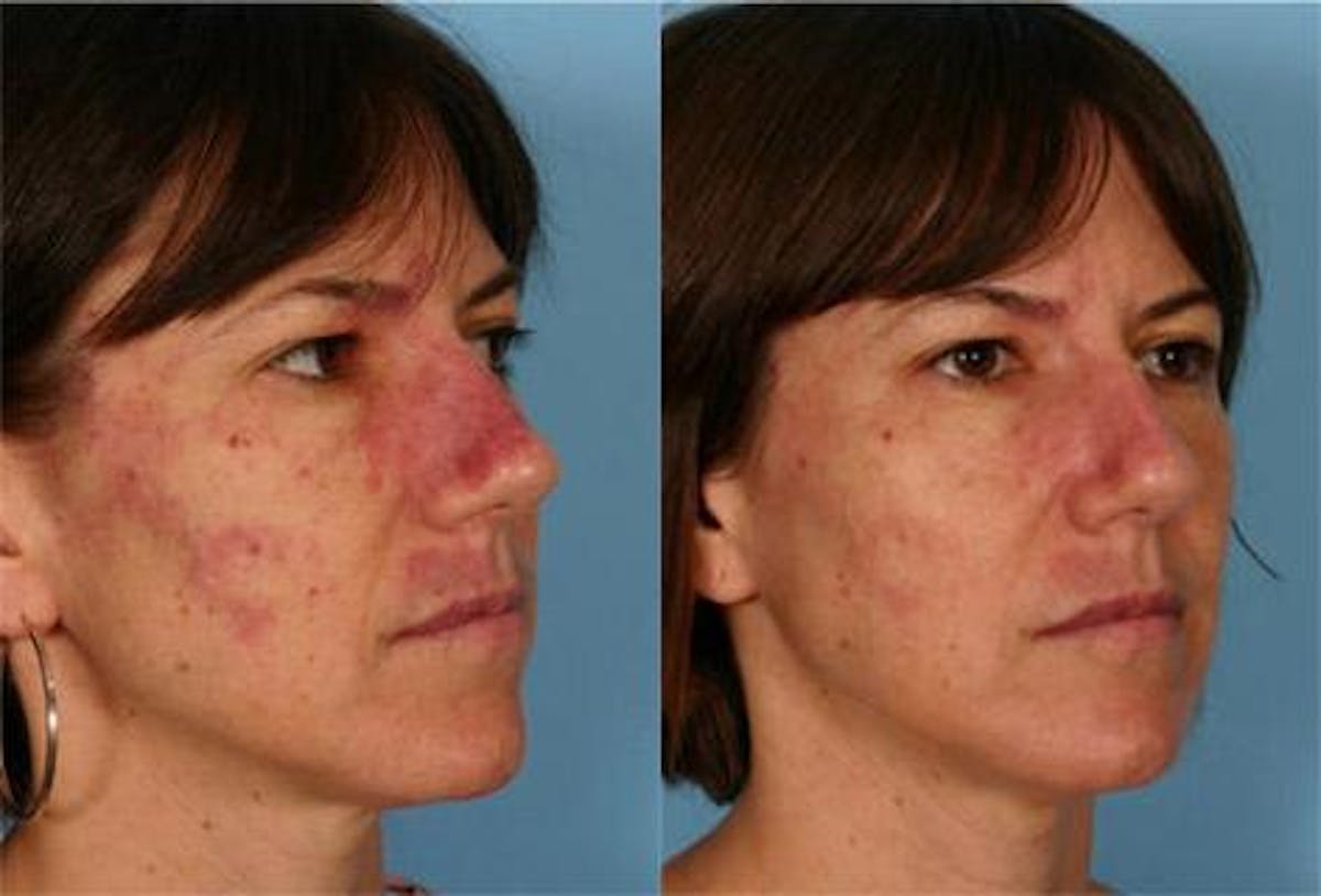 Birthmarks Before & After Gallery - Patient 357184 - Image 2