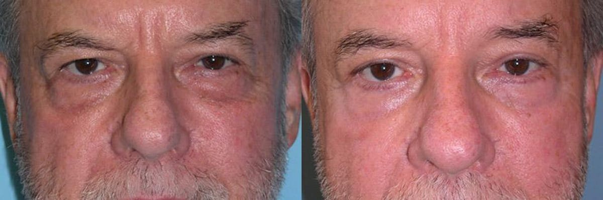 Eyelid Surgery (Blepharoplasty) Before & After Gallery - Patient 289617 - Image 3
