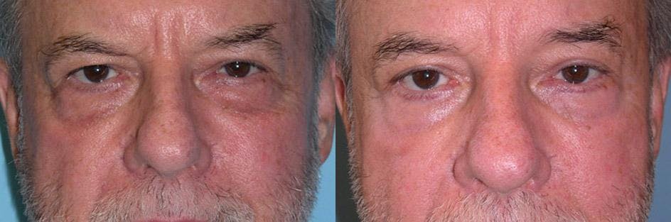 Eyelid Surgery (Blepharoplasty) Before & After Gallery - Patient 289617 - Image 1