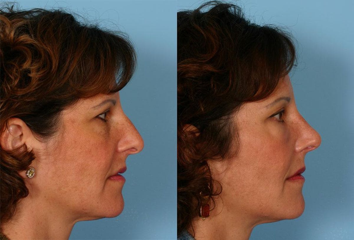 Rhinoplasty Before & After Gallery - Patient 264599 - Image 3