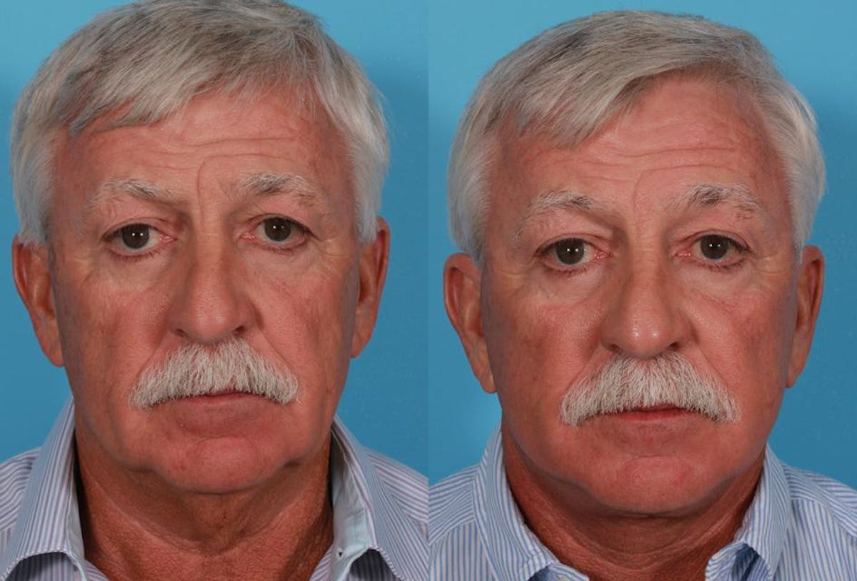 Facelift Before & After Gallery - Patient 229363 - Image 1
