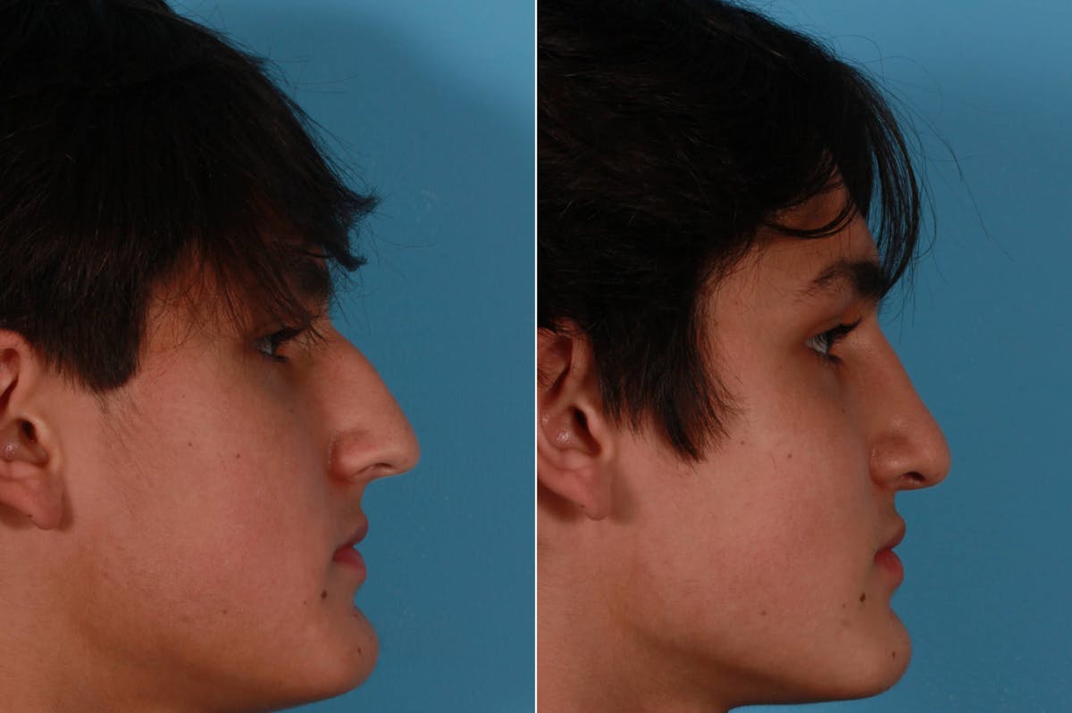 Nasal Obstruction Before & After Gallery - Patient 129983 - Image 2