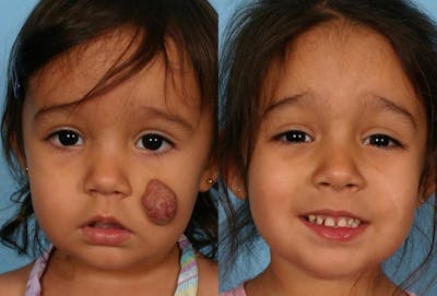 Birthmarks Before & After Gallery - Patient 187051 - Image 1