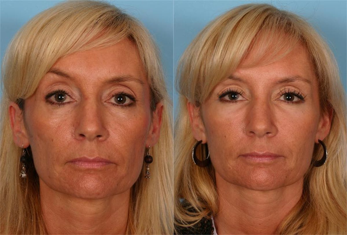Facial Fat Transfer Before & After Gallery - Patient 418701 - Image 1