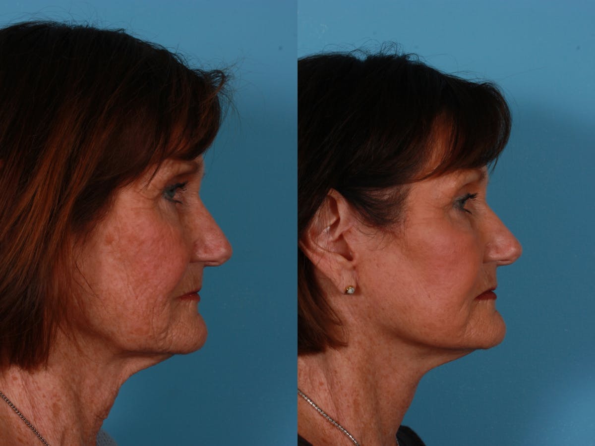 Limited Incision Facelift Before & After Gallery - Patient 583706 - Image 3