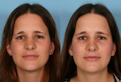 Rhinoplasty Before & After Gallery - Patient 148504 - Image 1