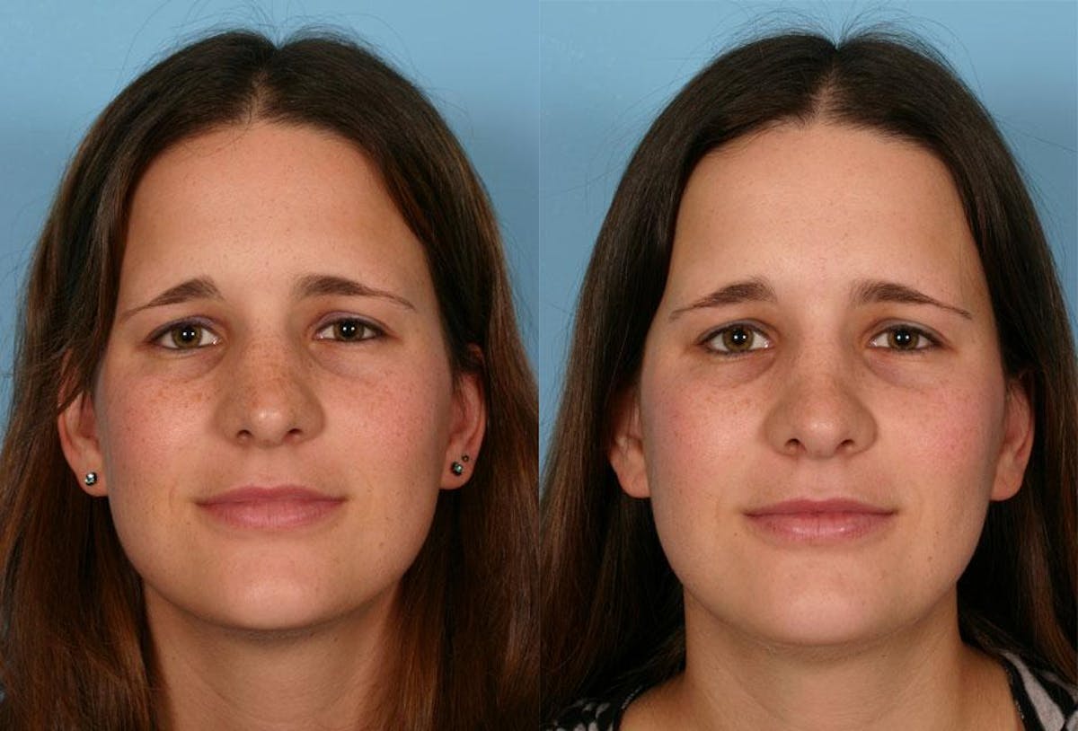 Rhinoplasty Before & After Gallery - Patient 148504 - Image 1