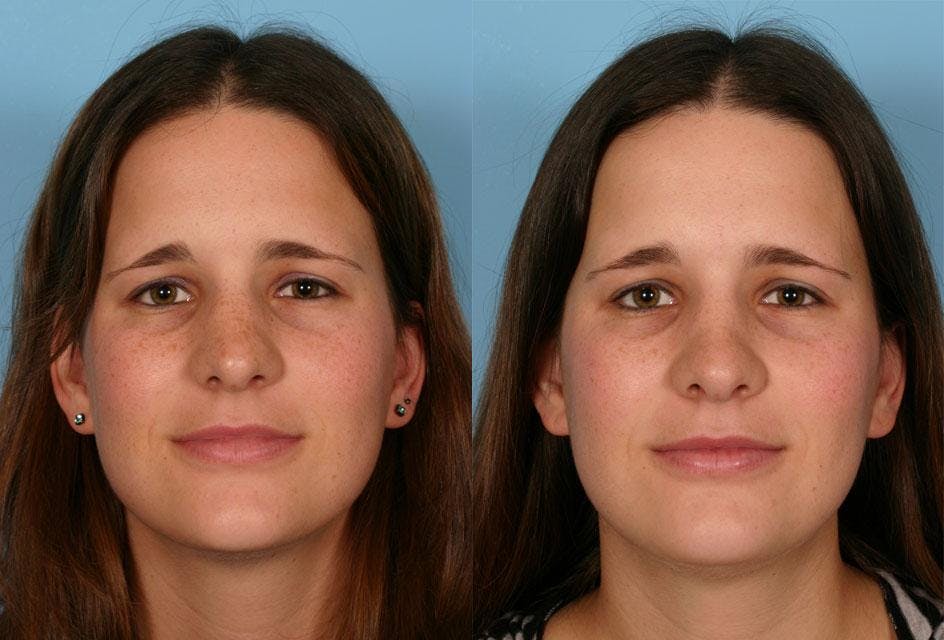 Rhinoplasty Before & After Gallery - Patient 148504 - Image 1