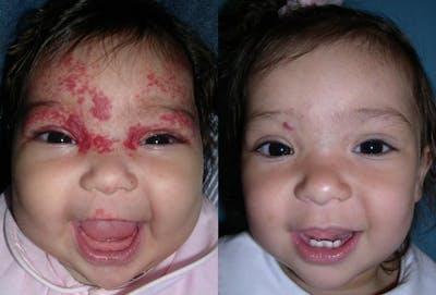 Birthmarks Before & After Gallery - Patient 406962 - Image 1