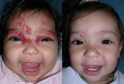 Birthmarks Before & After Gallery - Patient 406962 - Image 1