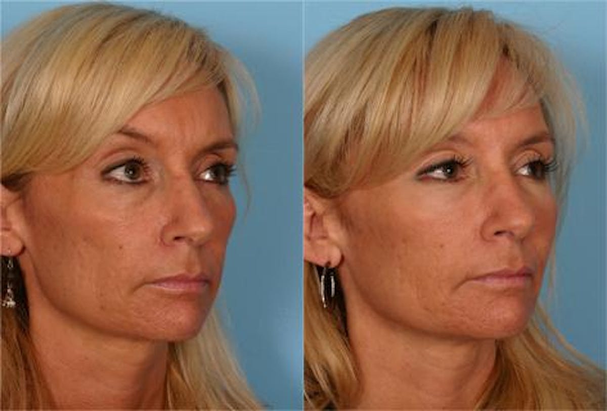 Facial Fat Transfer Before & After Gallery - Patient 418701 - Image 2
