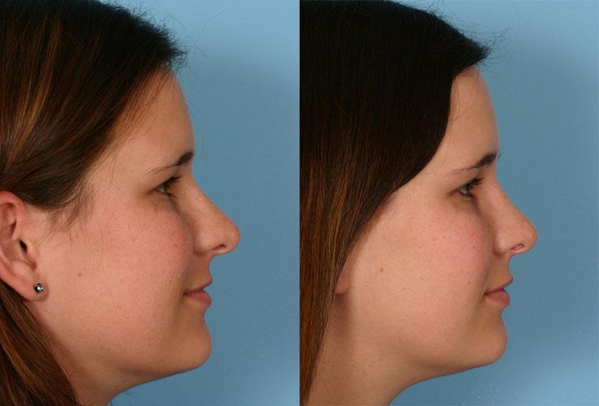 Rhinoplasty Before & After Gallery - Patient 148504 - Image 2
