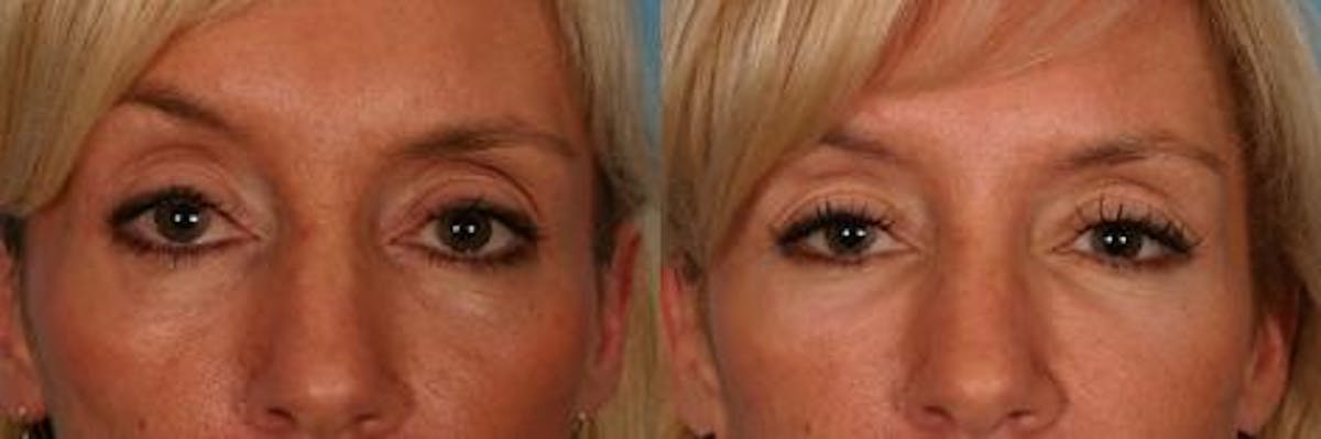 Facial Fat Transfer Before & After Gallery - Patient 418701 - Image 3