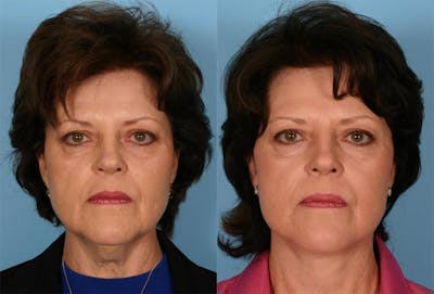 Facelift Before & After Gallery - Patient 387286 - Image 1