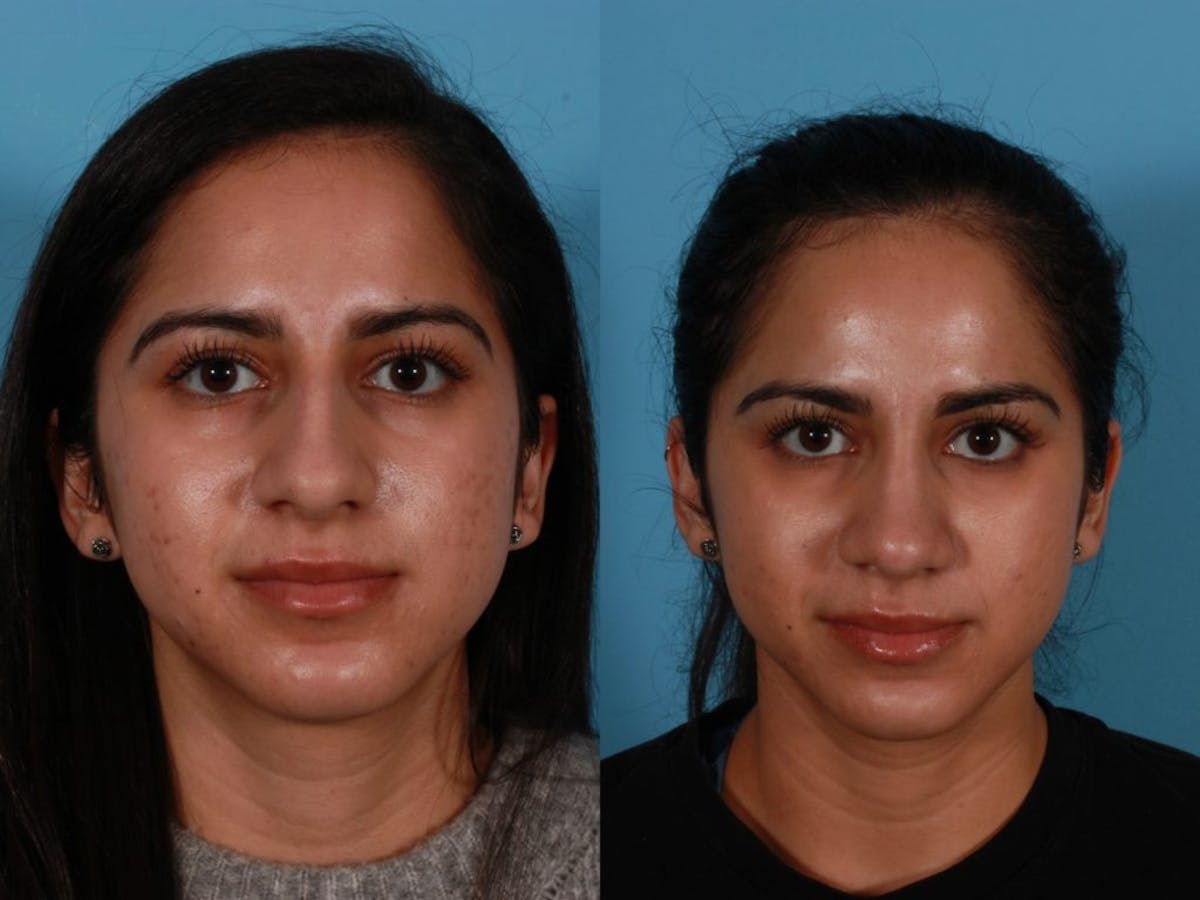 Nasal Obstruction Before & After Gallery - Patient 874593 - Image 1