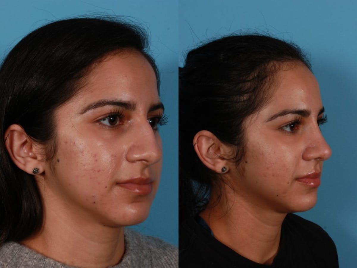 Nasal Obstruction Before & After Gallery - Patient 874593 - Image 2