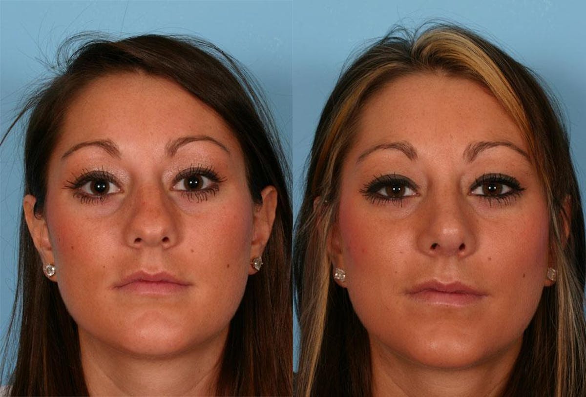 Rhinoplasty Before & After Gallery - Patient 385552 - Image 1