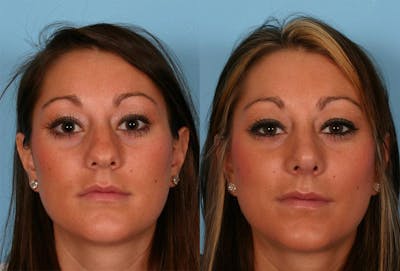 Rhinoplasty Before & After Gallery - Patient 385552 - Image 1