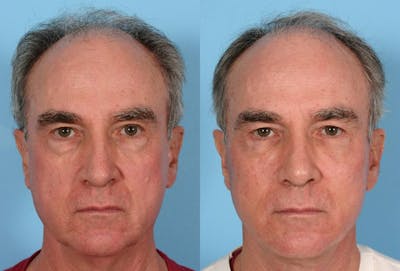 Facial Fat Transfer Before & After Gallery - Patient 132699 - Image 1