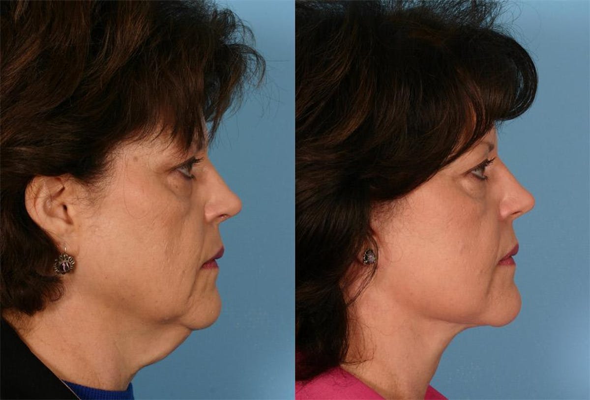 Facelift Before & After Gallery - Patient 387286 - Image 2