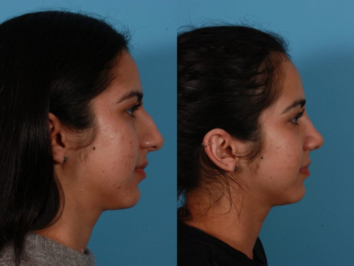 Nasal Obstruction Before & After Gallery - Patient 874593 - Image 3