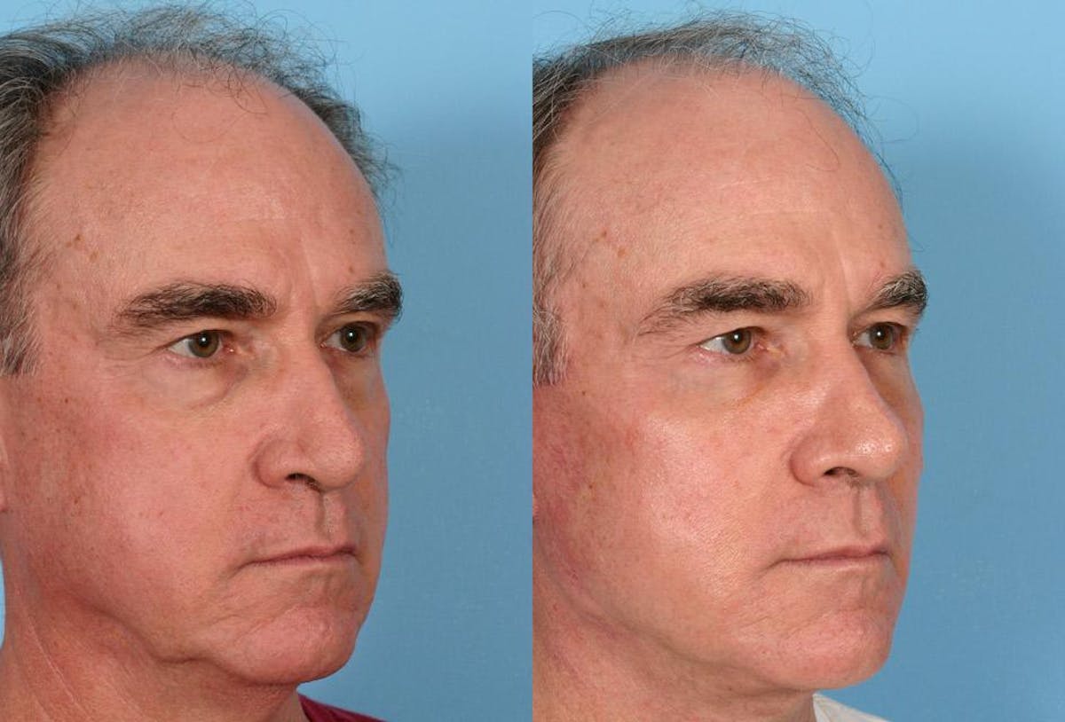 Facial Fat Transfer Before & After Gallery - Patient 132699 - Image 2