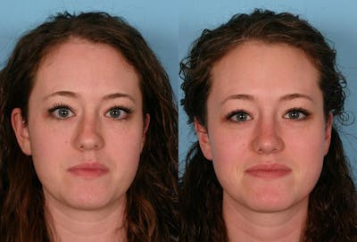 Rhinoplasty Before & After Gallery - Patient 258089 - Image 1