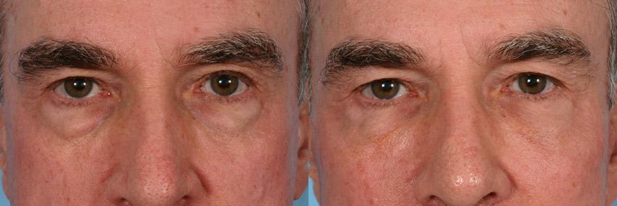 Facial Fat Transfer Before & After Gallery - Patient 132699 - Image 4