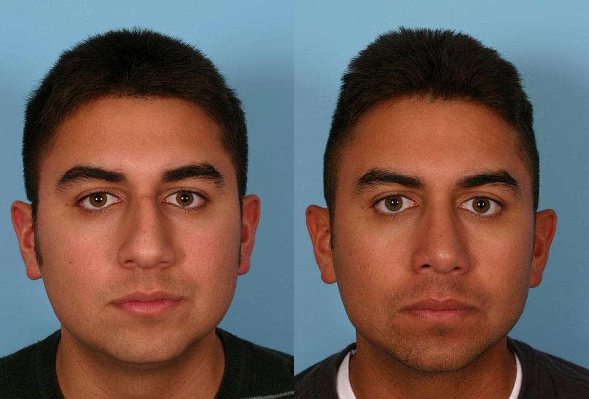 Rhinoplasty Before & After Gallery - Patient 309808 - Image 1