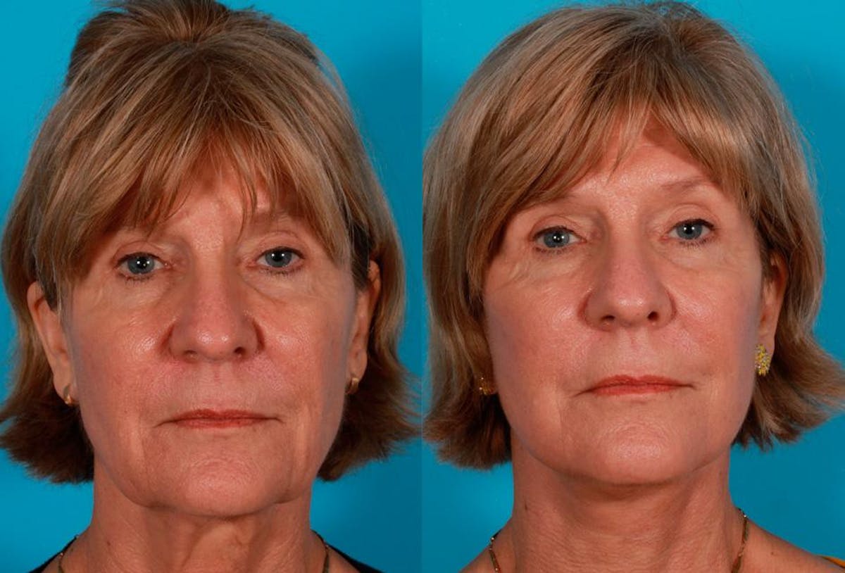 Facelift Before & After Gallery - Patient 504011 - Image 1