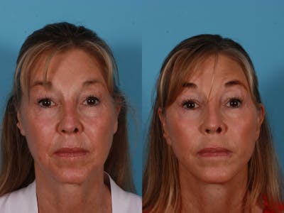Limited Incision Facelift Before & After Gallery - Patient 289625 - Image 1