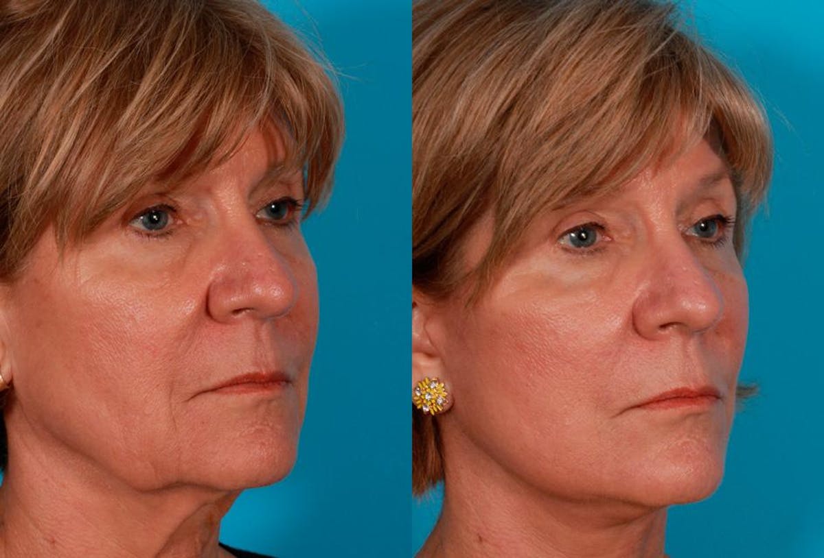 Facelift Before & After Gallery - Patient 504011 - Image 2