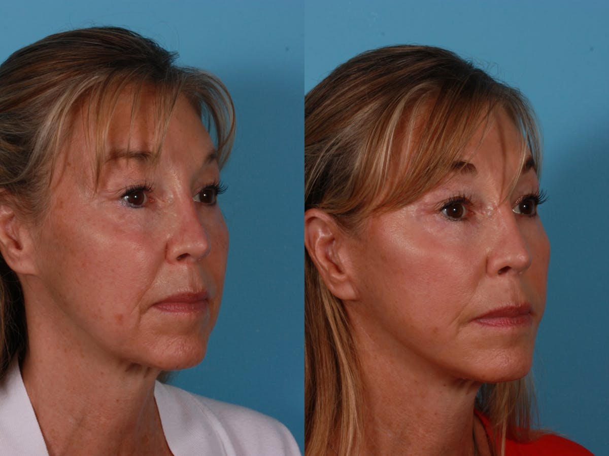 Limited Incision Facelift Before & After Gallery - Patient 289625 - Image 2
