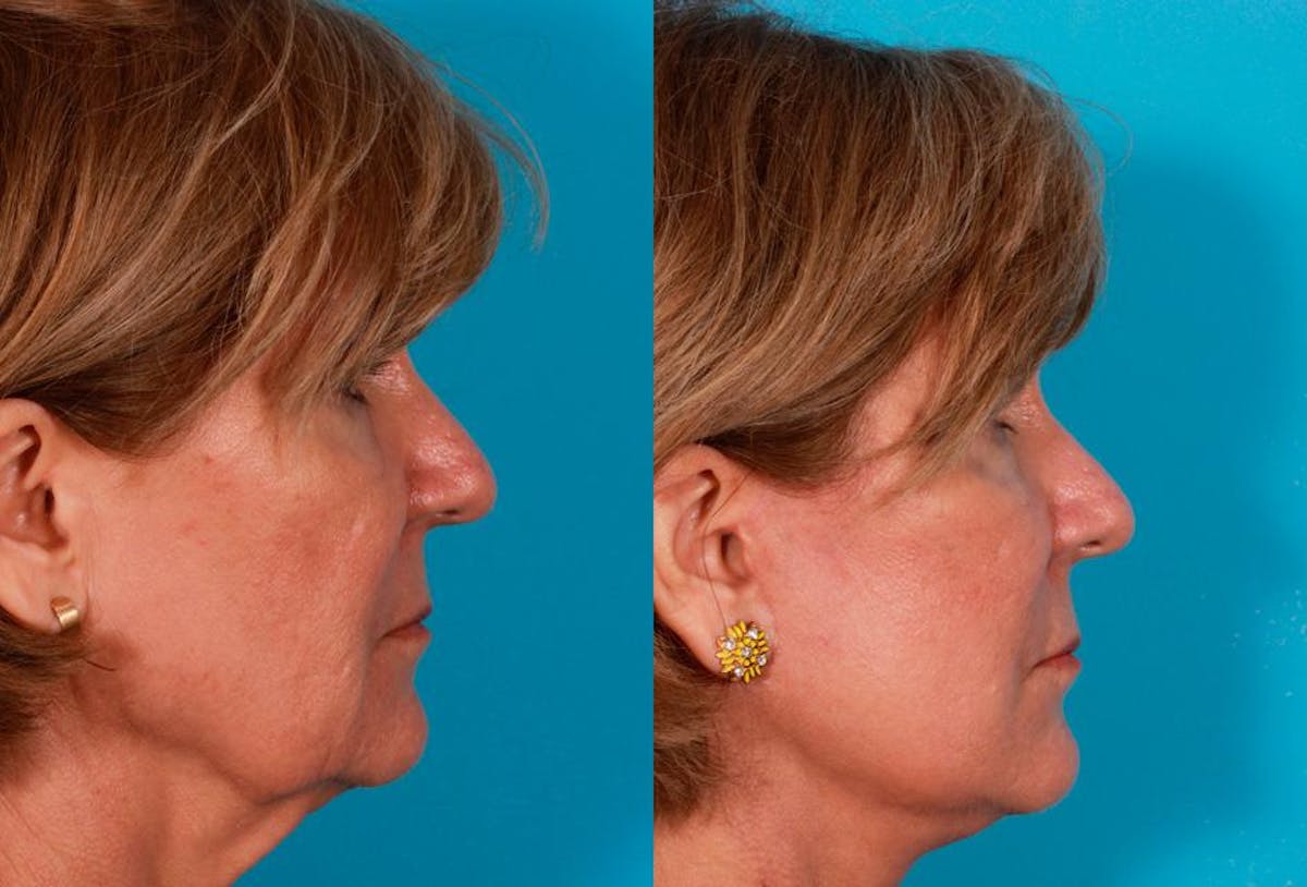 Facelift Before & After Gallery - Patient 504011 - Image 3