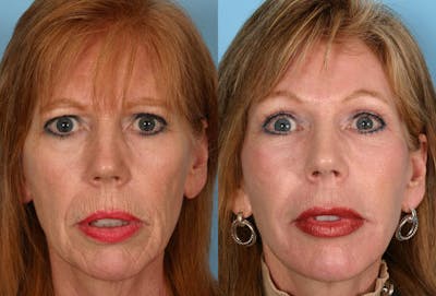 Facial Fat Transfer Before & After Gallery - Patient 287453 - Image 1
