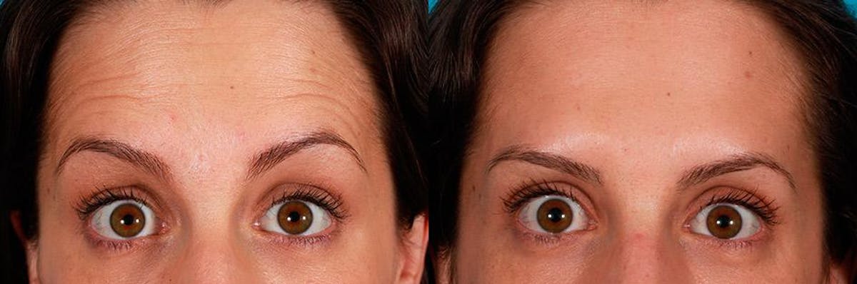Botox Before & After Gallery - Patient 322749 - Image 1
