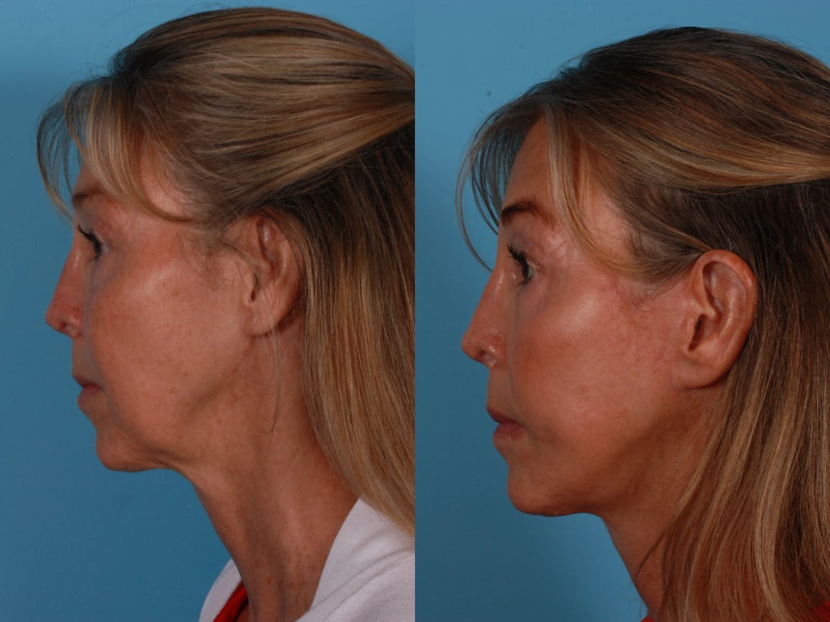 Limited Incision Facelift Before & After Gallery - Patient 289625 - Image 3