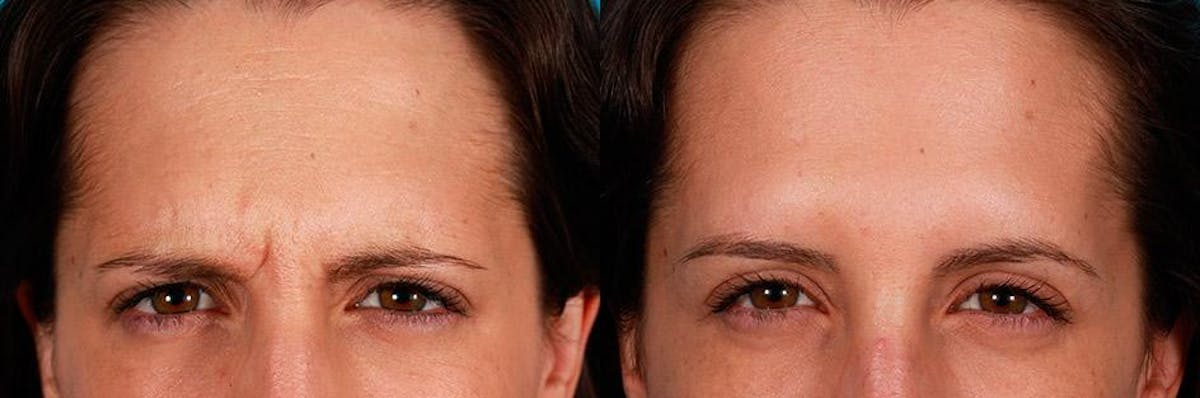 Botox Before & After Gallery - Patient 322749 - Image 2