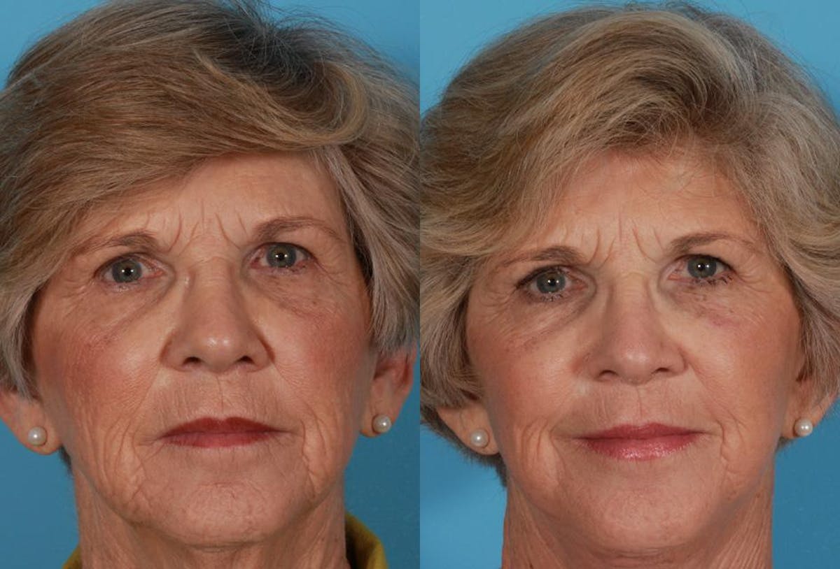 Facelift Before & After Gallery - Patient 177184 - Image 1