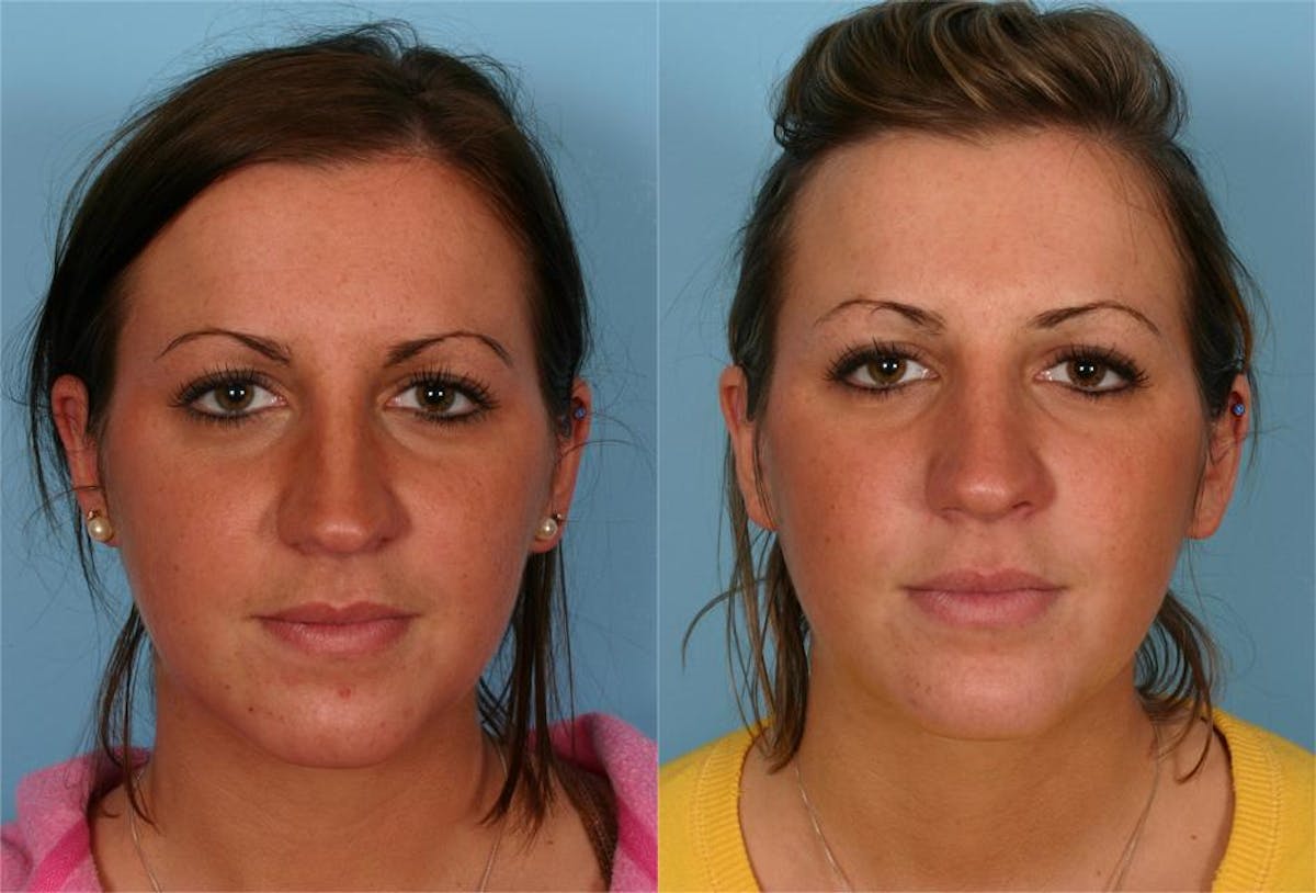 Rhinoplasty Before & After Gallery - Patient 570258 - Image 1