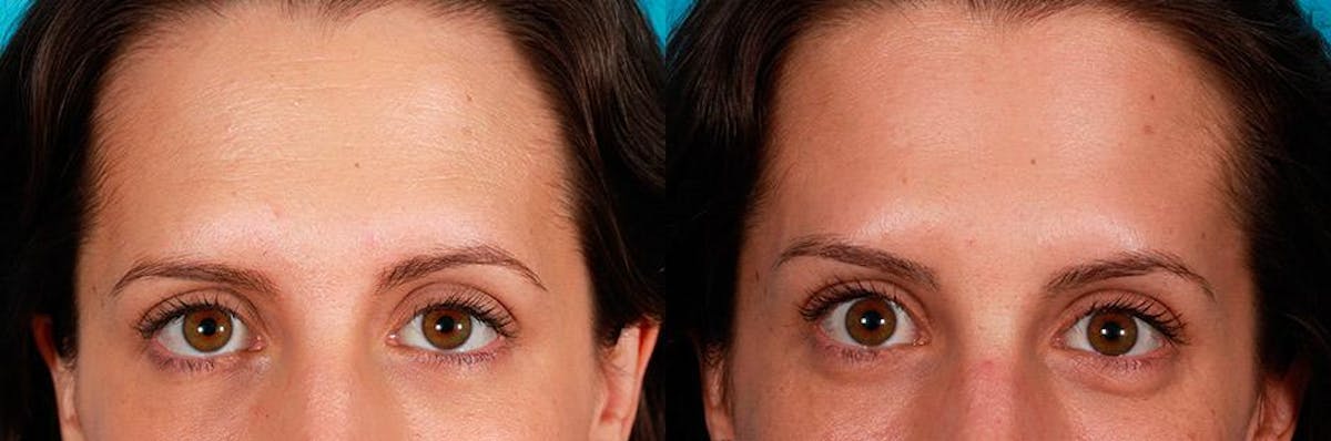 Botox Before & After Gallery - Patient 322749 - Image 3