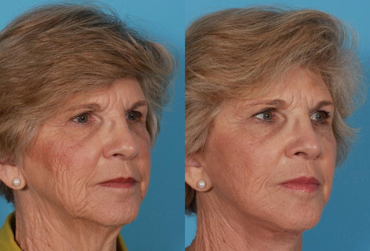 Facelift Before & After Gallery - Patient 177184 - Image 2