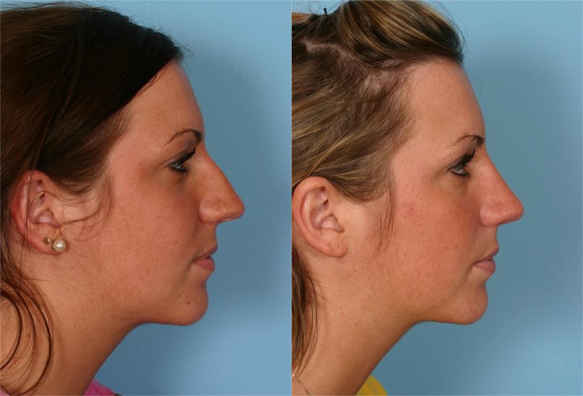Rhinoplasty Before & After Gallery - Patient 570258 - Image 2