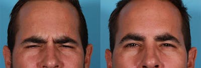 Botox Before & After Gallery - Patient 104943 - Image 1