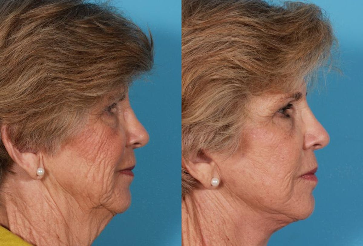 Facelift Before & After Gallery - Patient 177184 - Image 3