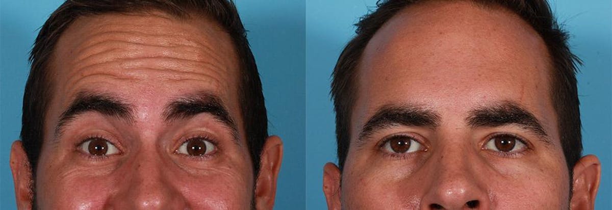 Botox Before & After Gallery - Patient 104943 - Image 2
